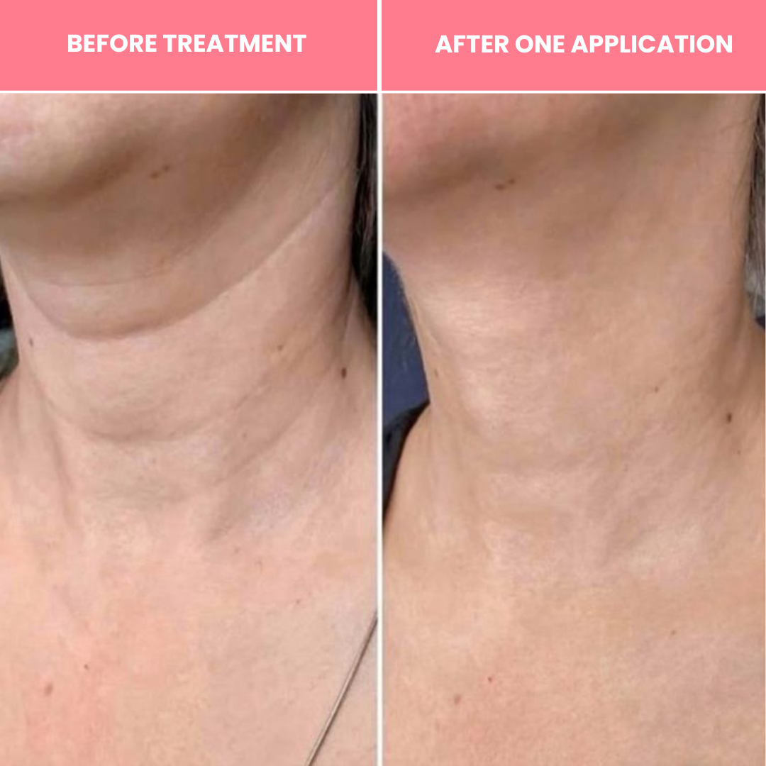 Vitaris Bio-Collagen Necklift Mask - Younger Neck After 1 Use